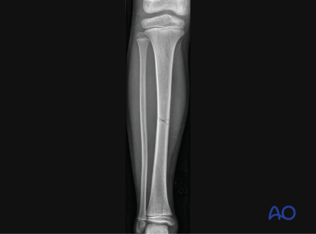 Teleflex Training Bones - Children's Tibia