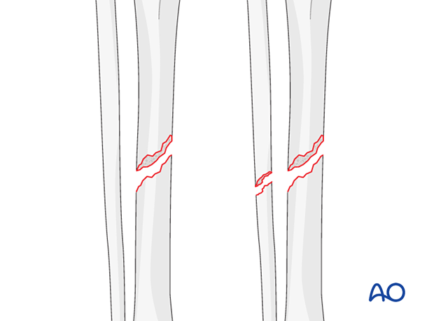 Simple oblique tibial shaft fractures, isolated tibia or associated with a fibular fracture