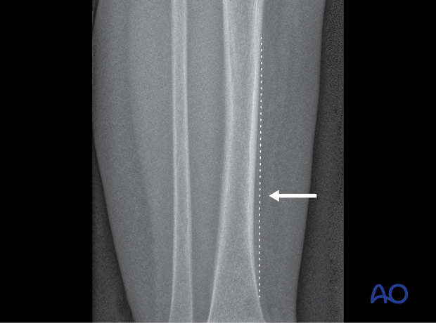 X-ray of a toddler’s fracture