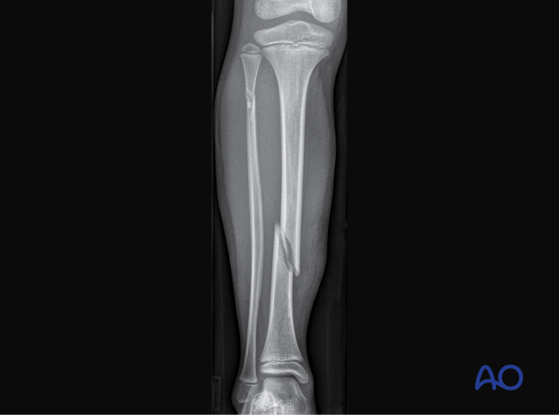 Oblique tibial shaft fracture with associated proximal fibular fracture