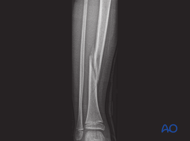 Isolated tibial shaft fracture with varus deformity