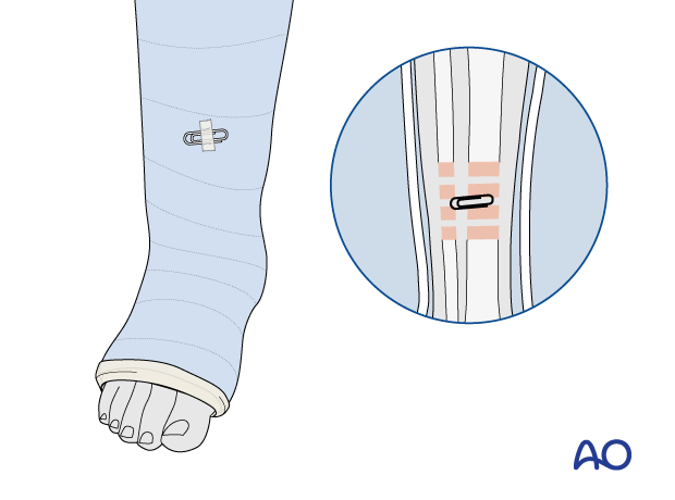 Paper clip marker outside of a long leg cast for location of fracture zone