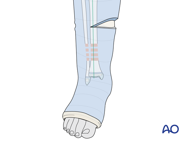 Cast wedging in a long leg cast of a tibial shaft fracture