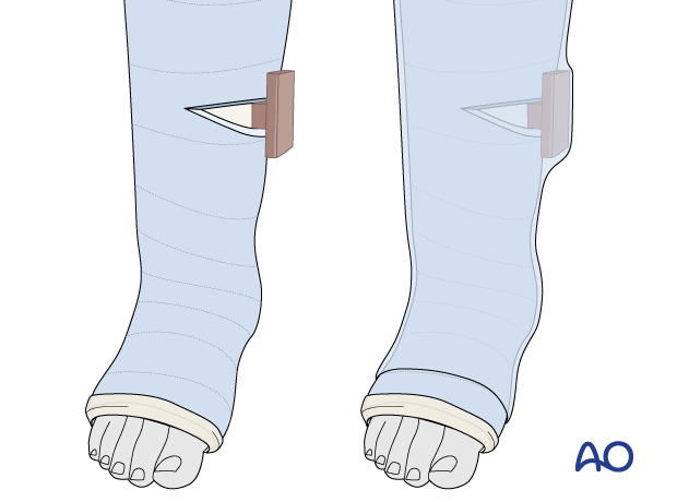 Cast wedging in a long leg cast of a tibial shaft fracture