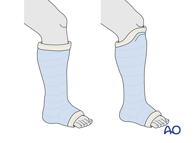 Below-knee cast and patella tendon bearing cast (Sarmiento)