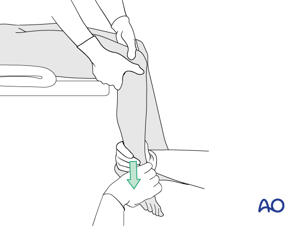 Pediatric patient positioned supine on an operating table with the legs hanging over the edge and closed reduction with traction