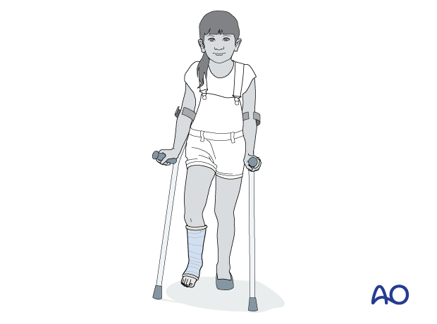 Non-weight-bearing crutches mobilization