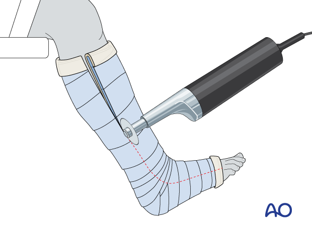 Circumferential cast swelling accommodation removable device