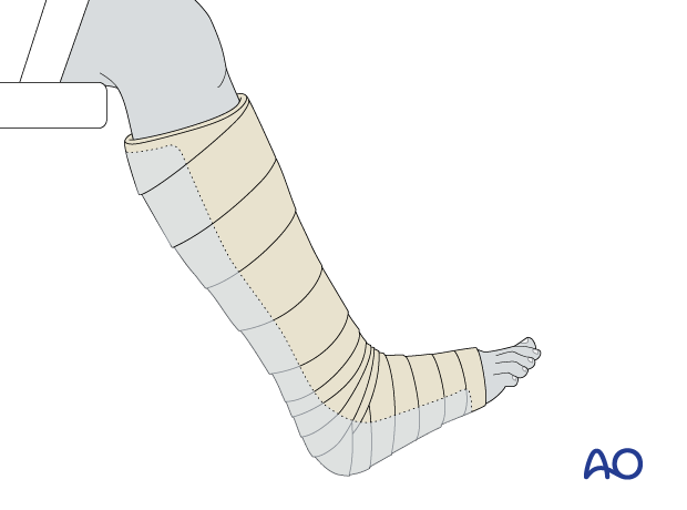 Application of a short leg splint