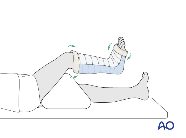 Folding bandage and padding over the distal edge of the splint