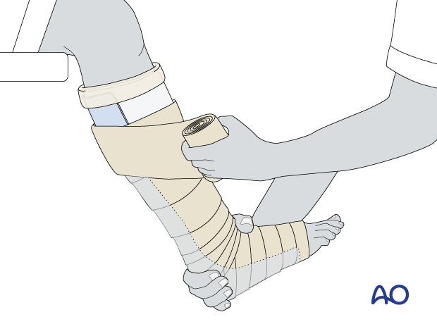 Application of a short leg splint