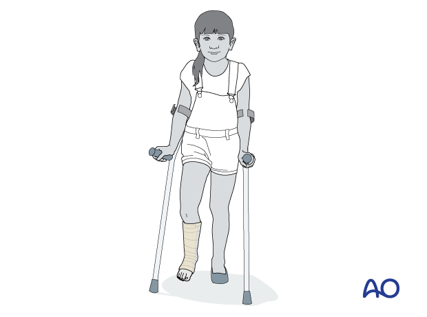 Pediatric patient with short leg splint and crutches