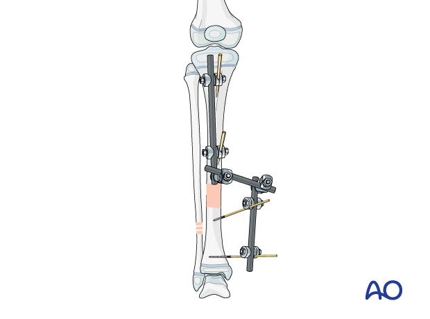 Stabilization of a pediatric tibial shaft fracture with a modular external fixator