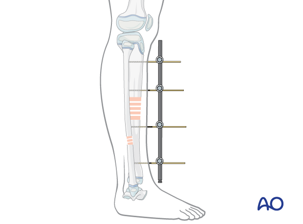 Stabilization of a pediatric tibial shaft fracture with a uniplanar external fixator