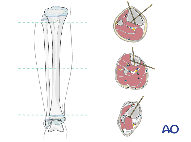 Safe zones for pin placement in the pediatric tibia