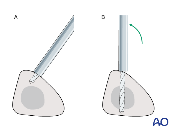 Drilling for anterior pin placement