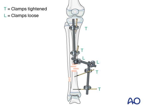 Frame assembly of a modular external fixator stabilizing a pediatric tibial shaft fracture