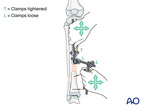 Reduction maneuver with the modular external fixator for stabilization of a pediatric tibial shaft fracture