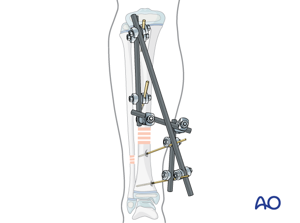 Modular external fixator stabilizing a pediatric tibial shaft fracture