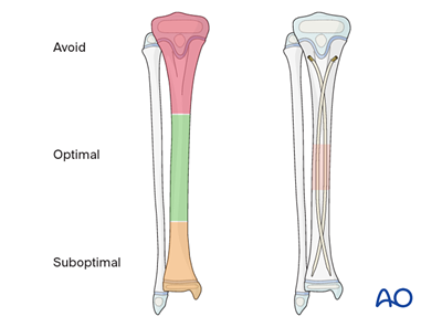Elastic nailing for Simple transverse tibial fracture