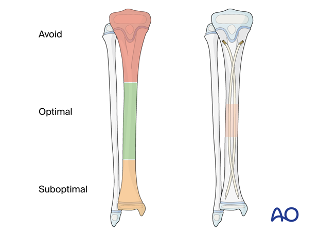 Fracture locations in the pediartic tibia optimal for stabilization with elastic nailing