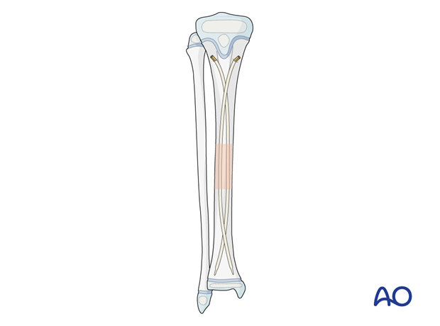 ESIN fixation of a pediatric tibial shaft fracture