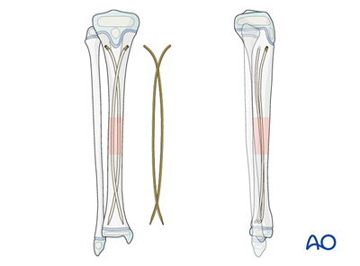 Elastic nailing for Simple transverse tibial fracture