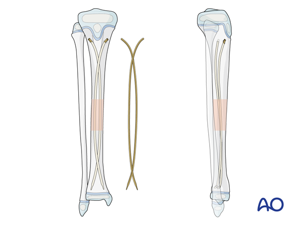 ESIN fixation of a pediatric tibial shaft fracture – nail configuration