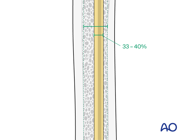 ESIN nail diameter in relation to the medullary canal