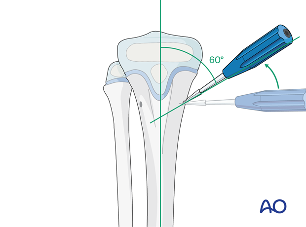 ESIN fixation of a pediatric tibial shaft fracture - Opening the proximal ESIN entry point