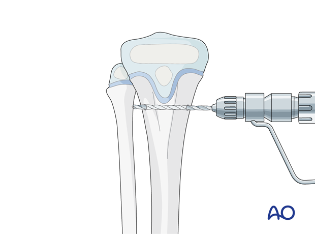 ESIN fixation of a pediatric tibial shaft fracture - Opening the proximal ESIN entry point