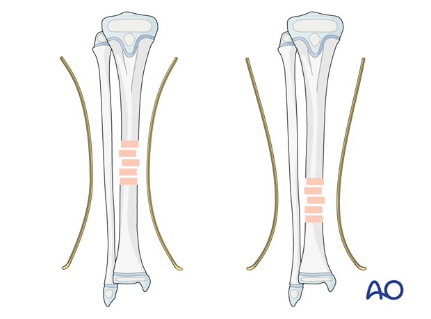 ESIN fixation of a pediatric tibial shaft fracture - Precontouring the nails