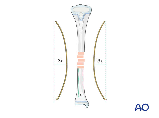 ESIN fixation of a pediatric tibial shaft fracture - Precontouring the nails