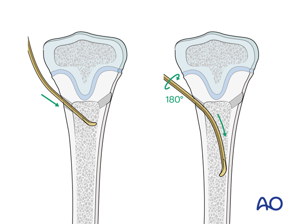 ESIN fixation of a pediatric tibial shaft fracture - Nail insertion