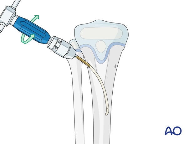 ESIN fixation of a pediatric tibial shaft fracture - Nail insertion