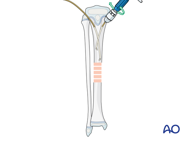 ESIN fixation of a pediatric tibial shaft fracture - Nail insertion