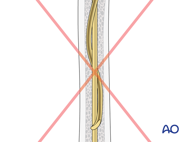 ESIN fixation of a pediatric tibial shaft fracture - Cork-screw phenomenon