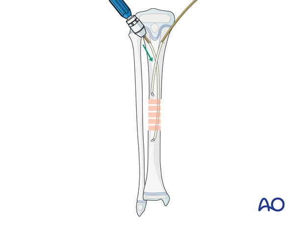 ESIN fixation of a pediatric tibial shaft fracture - Nail insertion