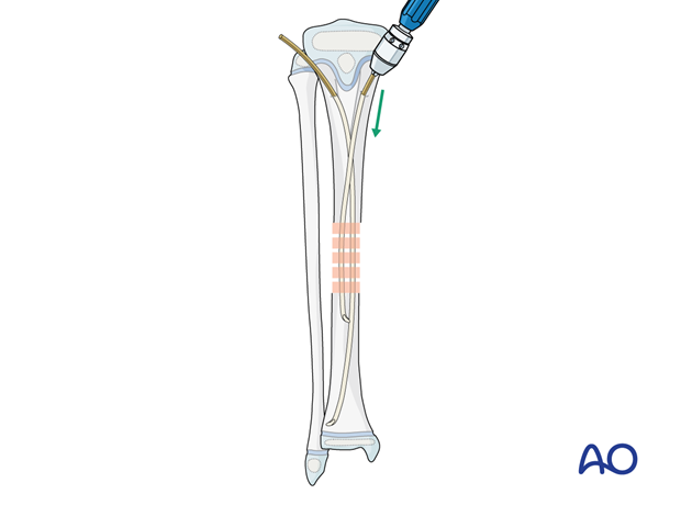 ESIN fixation of a pediatric tibial shaft fracture - Nail insertion