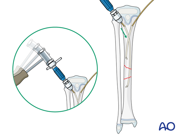 ESIN fixation of a segmental pediatric tibial shaft fracture - Nail insertion