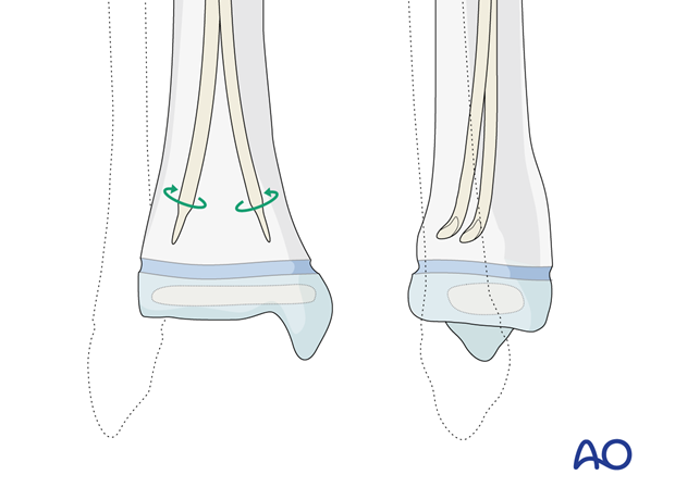 ESIN fixation of a segmental pediatric tibial shaft fracture - Advancing the nails past the fracture site