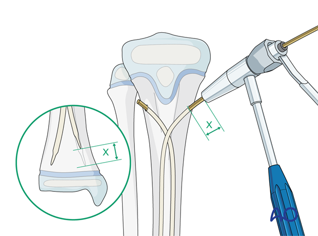 ESIN fixation of a segmental pediatric tibial shaft fracture – Nail cutting