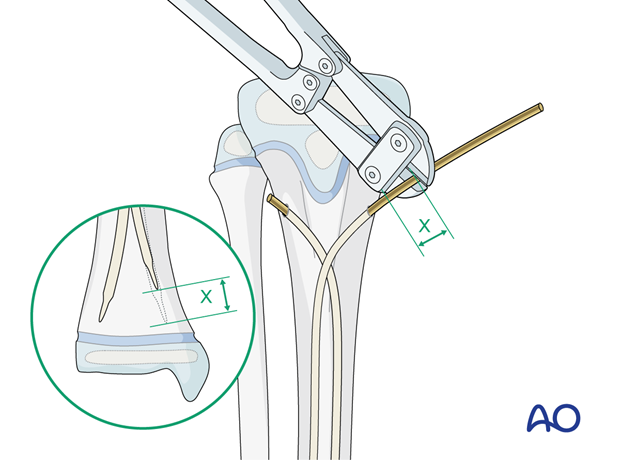 ESIN fixation of a segmental pediatric tibial shaft fracture – Nail cutting