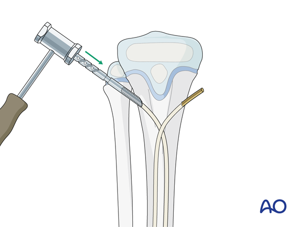 ESIN fixation of a segmental pediatric tibial shaft fracture – Final seating of the nails