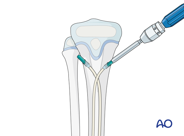 ESIN fixation of a segmental pediatric tibial shaft fracture – Application of end caps