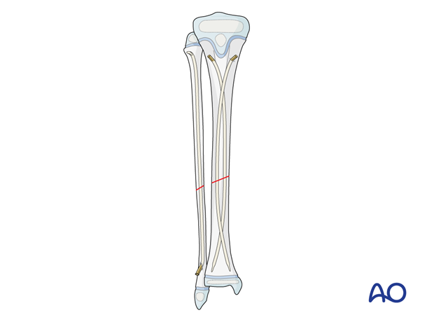 ESIN fixation of a pediatric tibial shaft fracture – fixation of an associated fibular fracture 