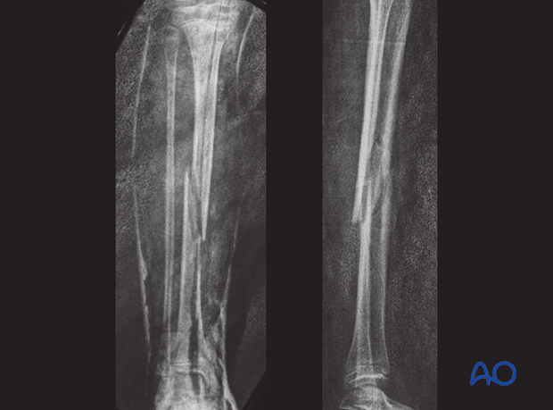 Simple oblique fracture of the tibial shaft