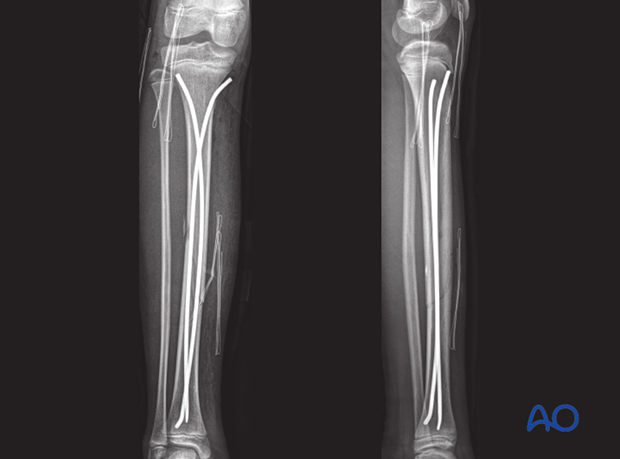 AP and lateral x-ray after reduction and fixation with elastic nails