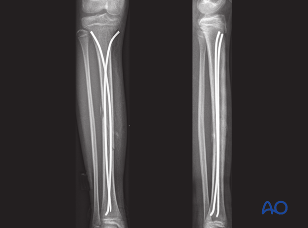 AP and lateral x-rays, 4 weeks after surgery, showing maintained reduction and signs of bone healing