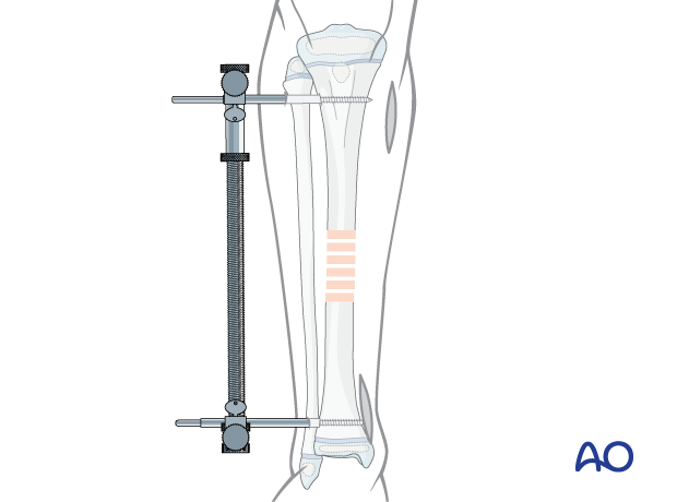 Distractor applied to help maintain length during MIPO of a pediatric tibial shaft fracture 